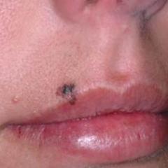 Mole on lip