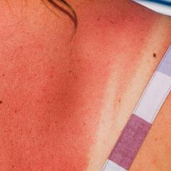 Sunburnt back